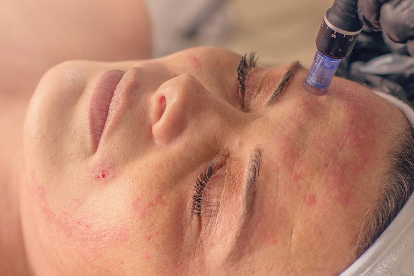 Rf Microneedling Treatment
